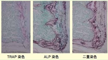 左上图是trap染色,右上图是alp染色.下图是两者的双重染色.